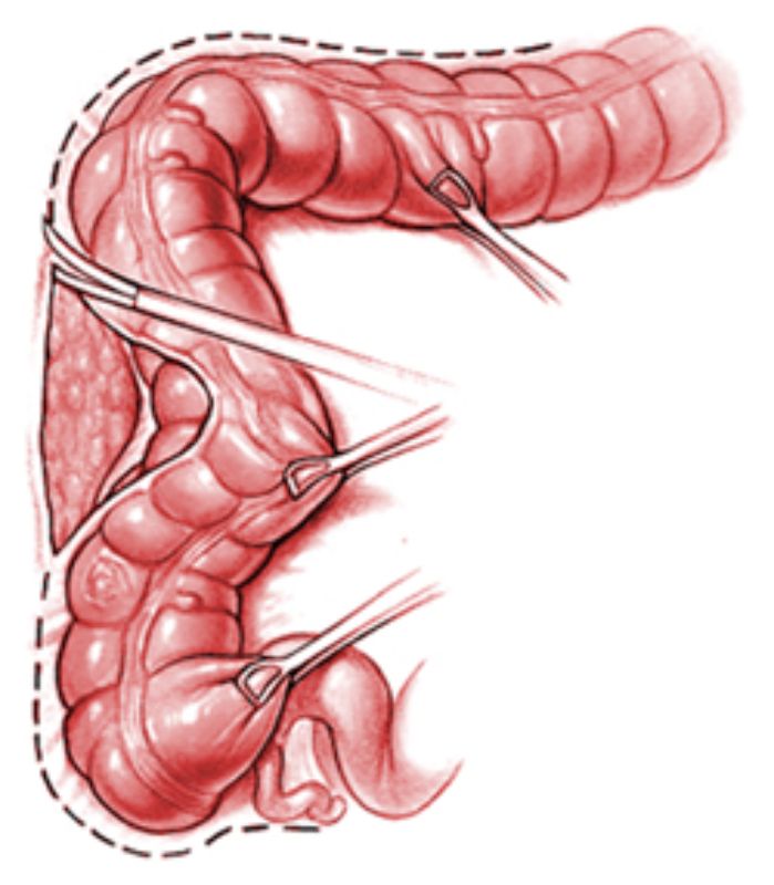 Dr Lockie is a Trained Cholectomy Specialist